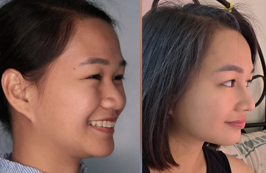Rhinoplasty Slide