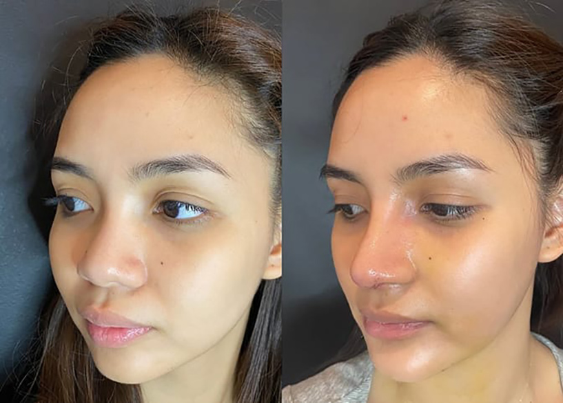 Rhinoplasty Slide