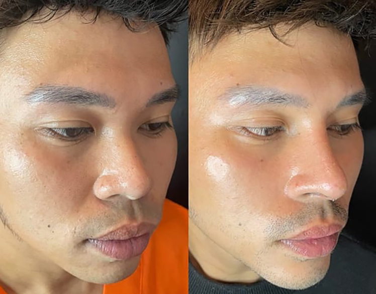 Rhinoplasty Slide