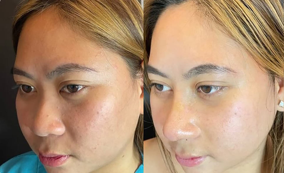 Rhinoplasty Slide