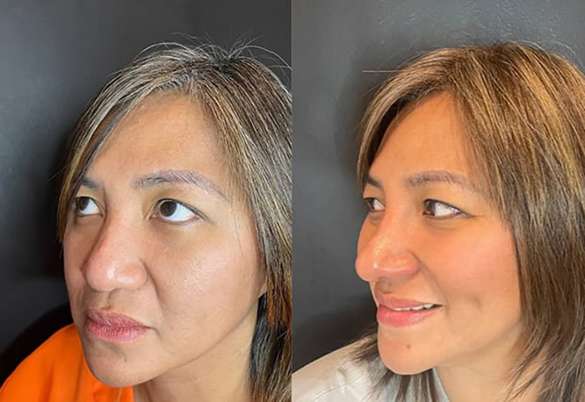 Rhinoplasty Slide