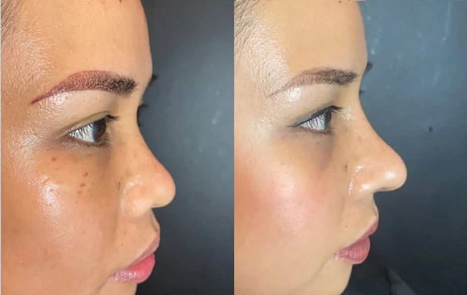 Rhinoplasty Slide